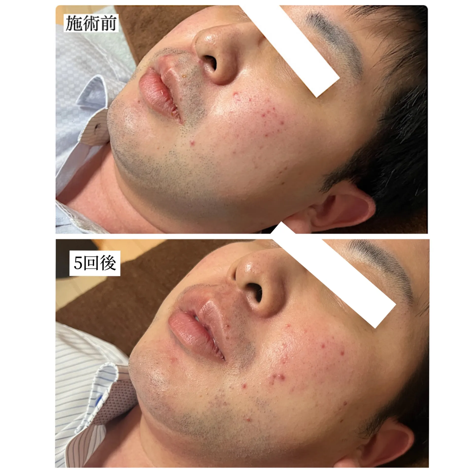 大人気のヒゲ脱毛☆