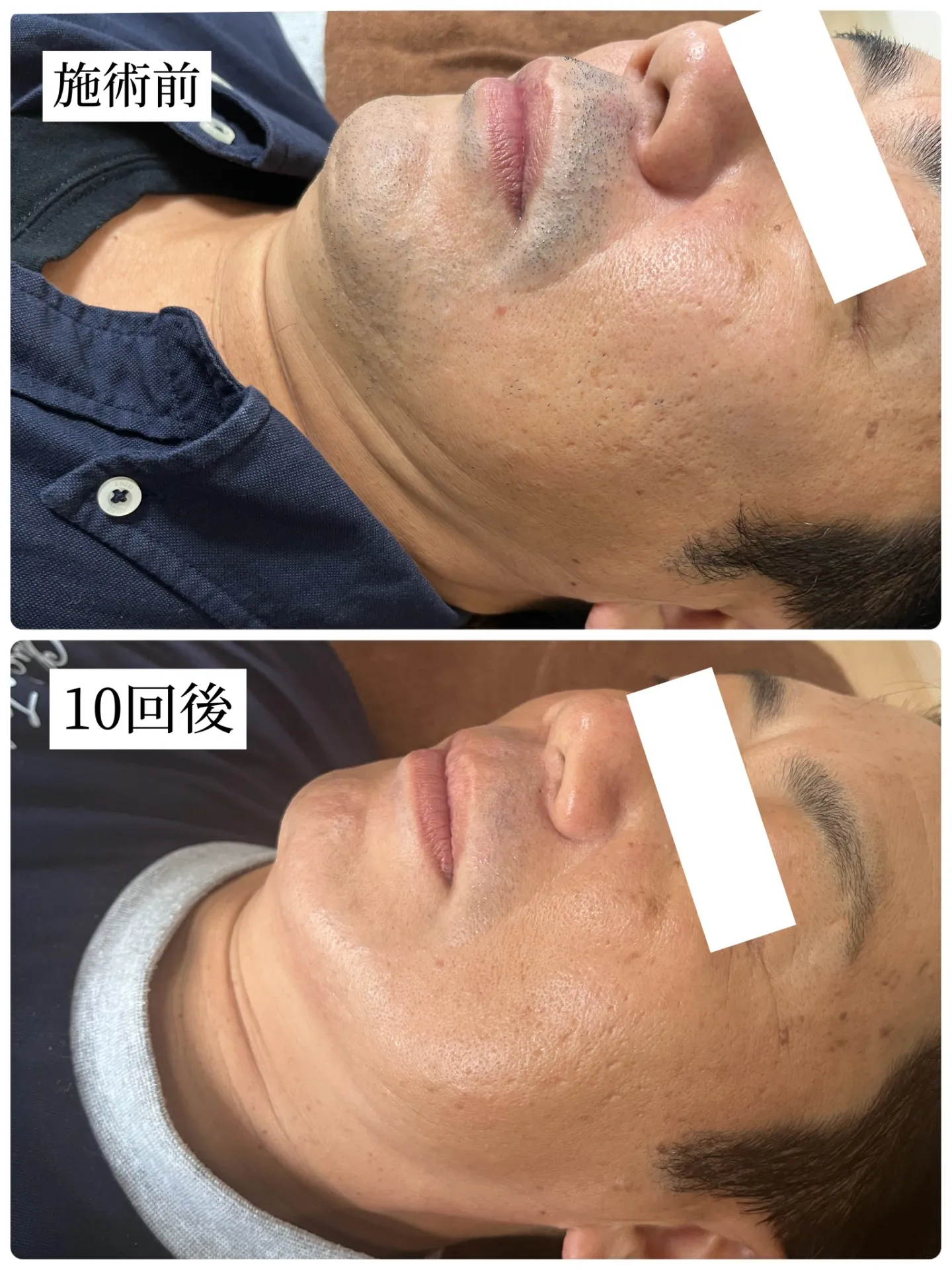 大人気のヒゲ脱毛☆